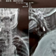 Radiografía que muestra la bala que ha vivido en el cuello de Zhao la mayor parte de su vida